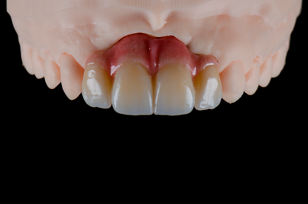 zirconia 03