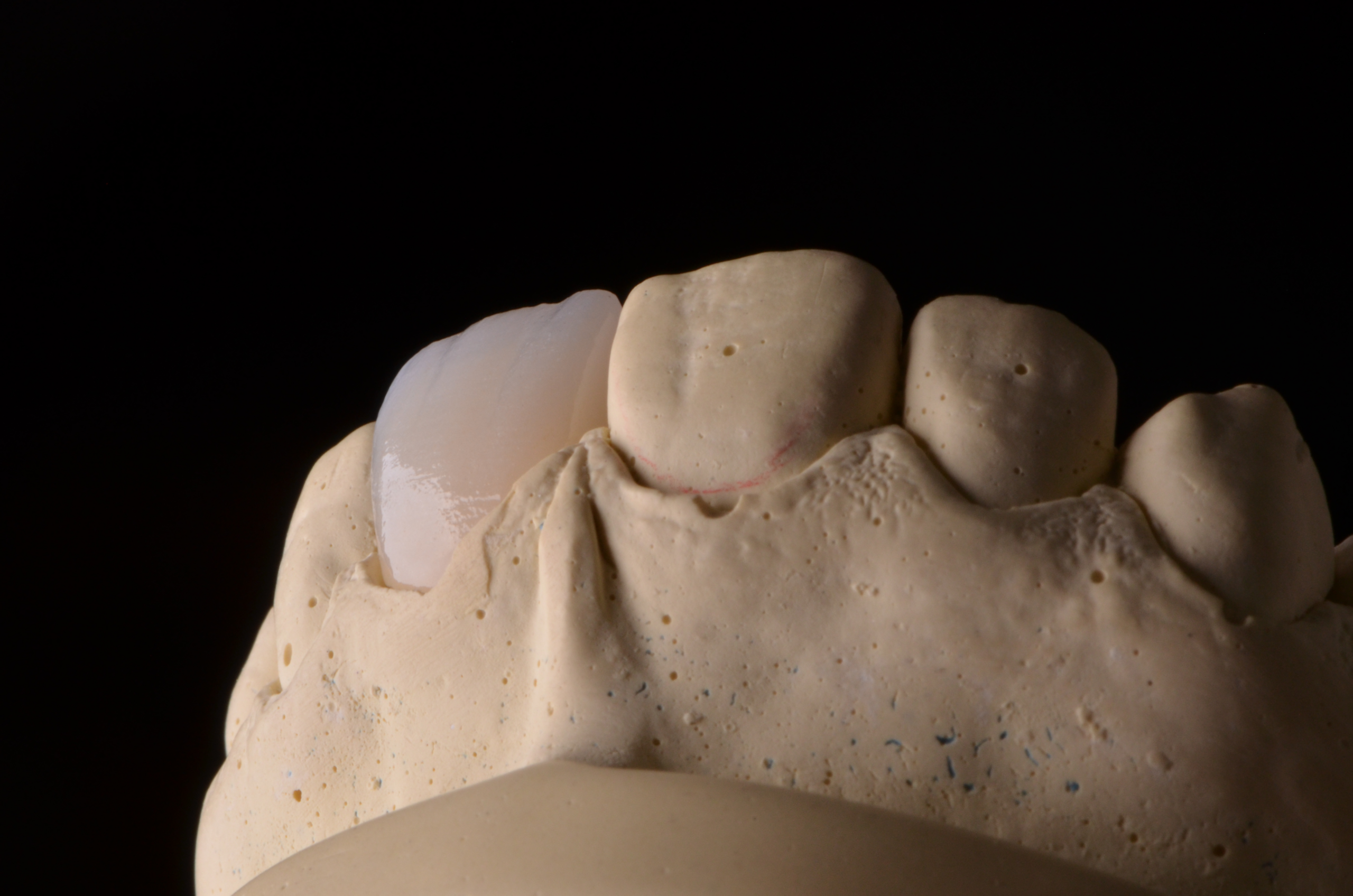 zirconia 06